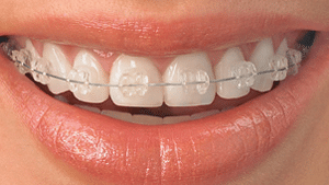 Ceramic Braces