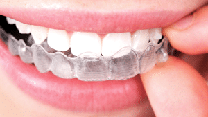 Invisalign clear aligners 